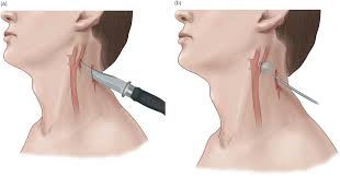 HEI NECK TRAUMA